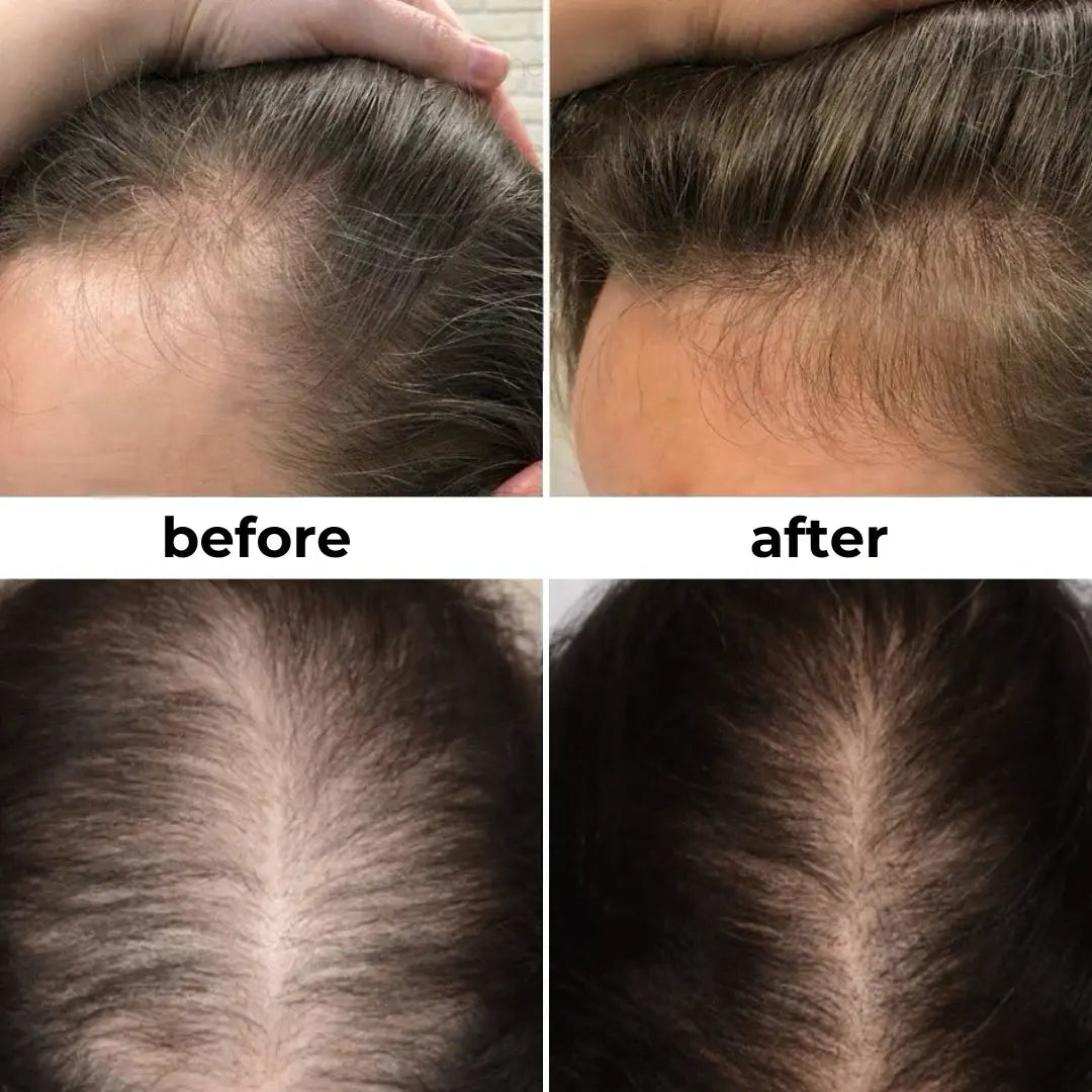 Before and after comparison of hair growth treatment on a person's head.