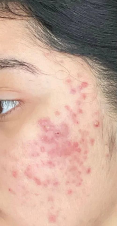 argan oil treatment